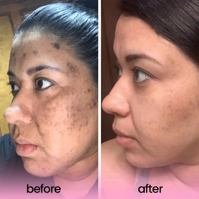 TURMERIC & KOJIC ACID PADS (40 pads)